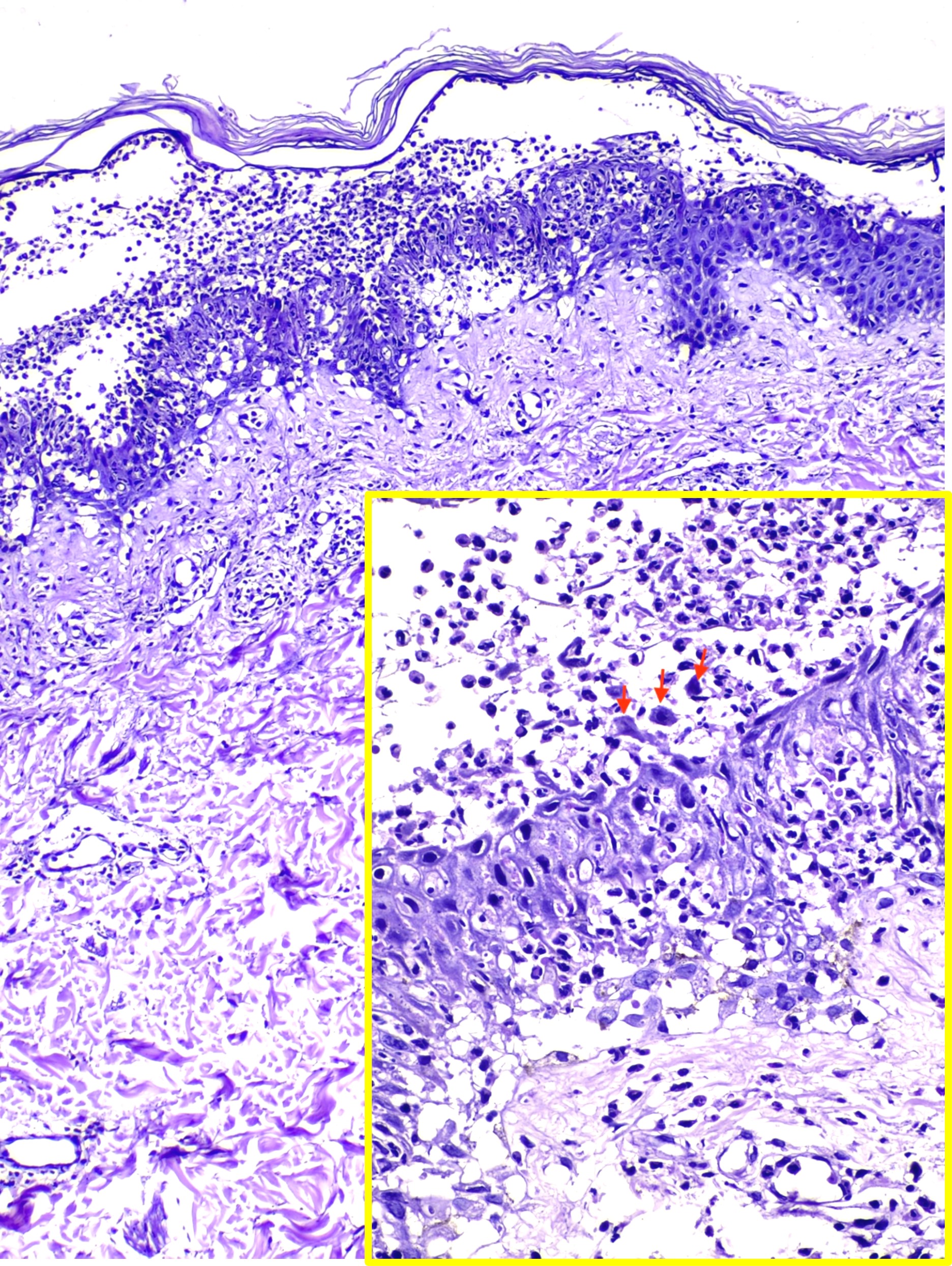 <p>Intraepidermal Neutrophilic IgA Pemphigus