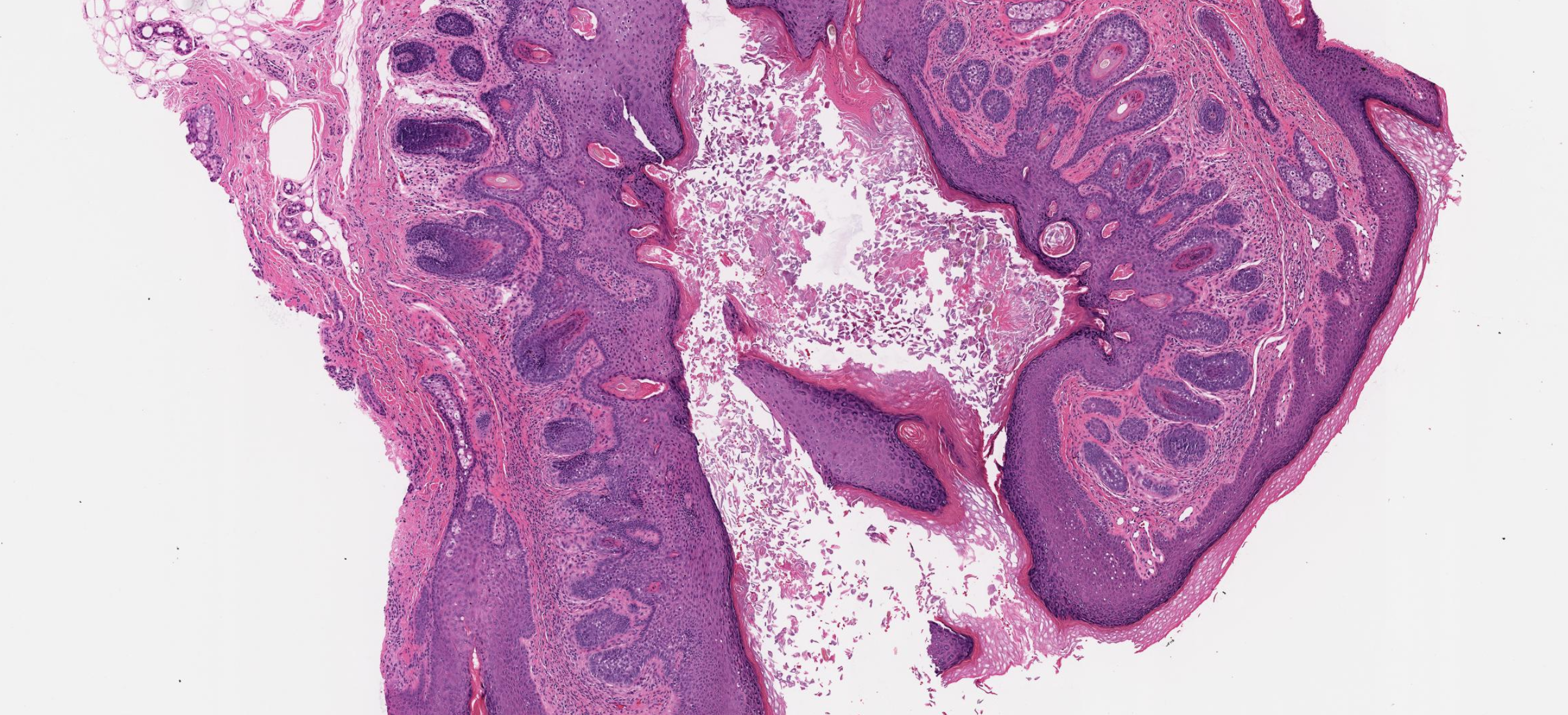 Trichofolliculoma Pathologic Specimen