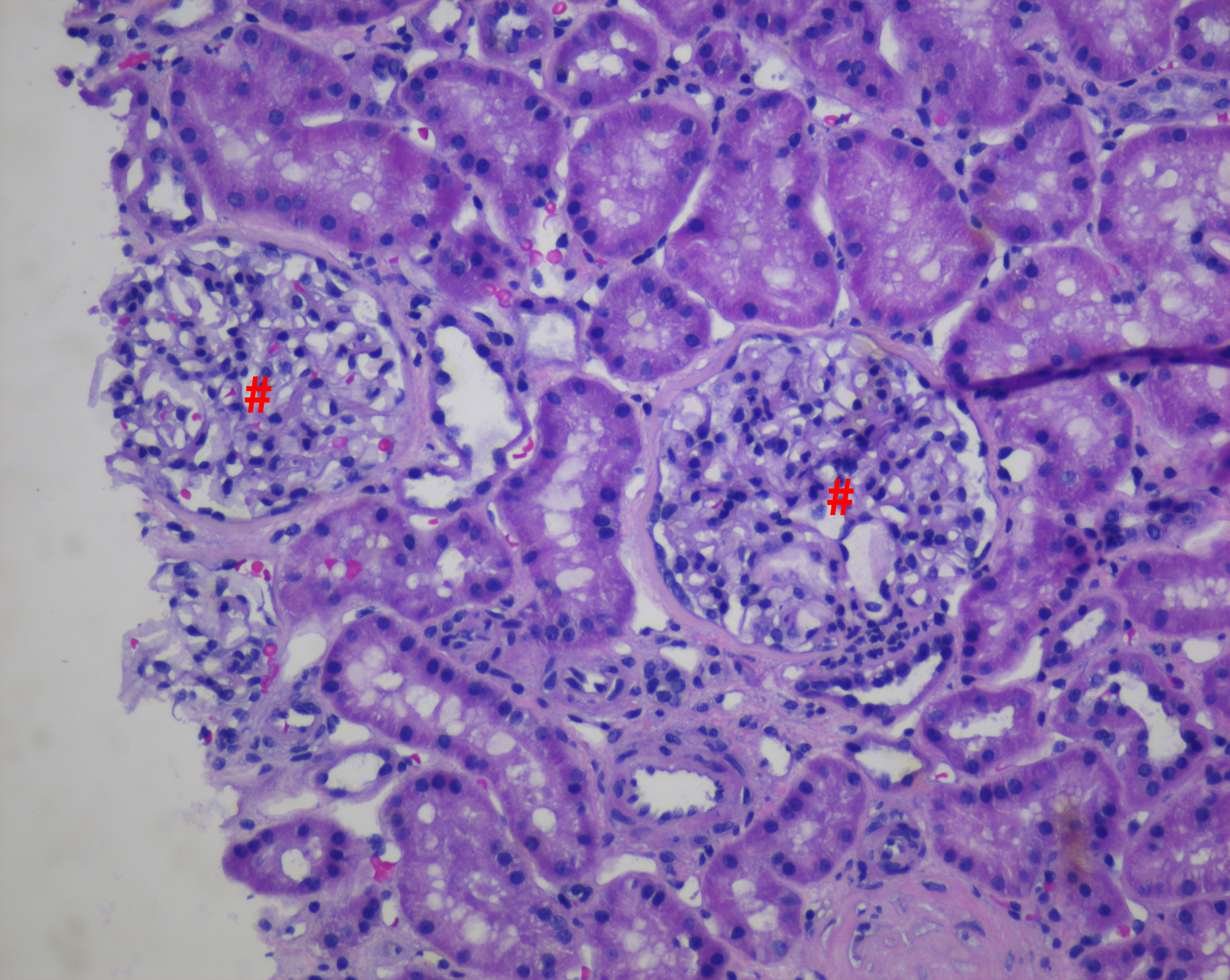 Light Microscopy of Renal Parenchyma in Thin Basement Membrane Nephropathy