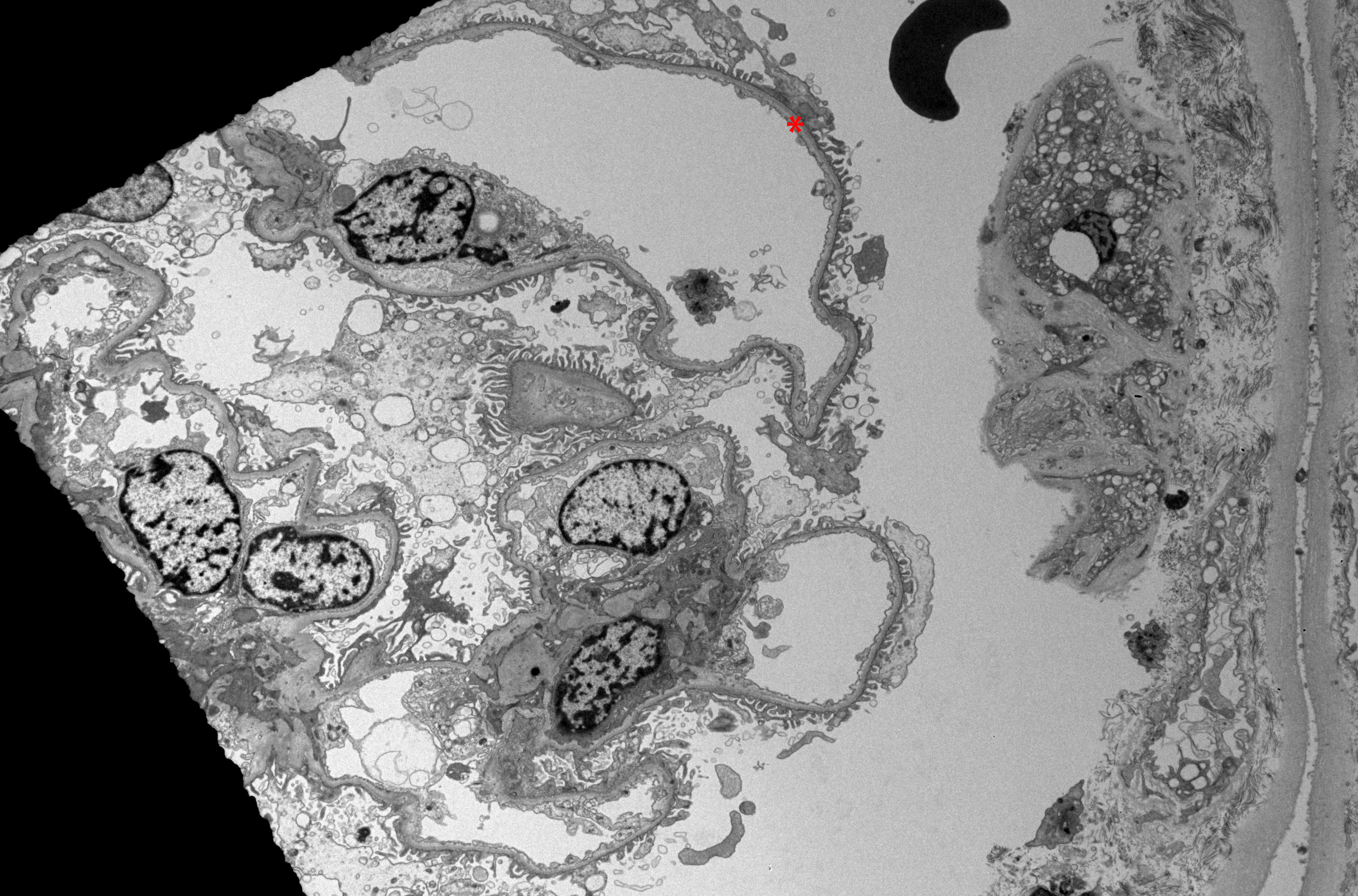 Electron Microscopy of Renal Parenchyma in Thin Basement Membrane Nephropathy