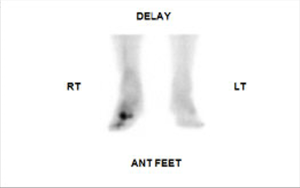 Three-phase Bone Scintigraphy: Bone Phase