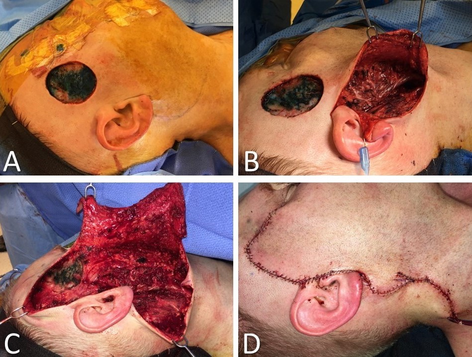 <p>Cervicofacial Advancement-Rotation Flap