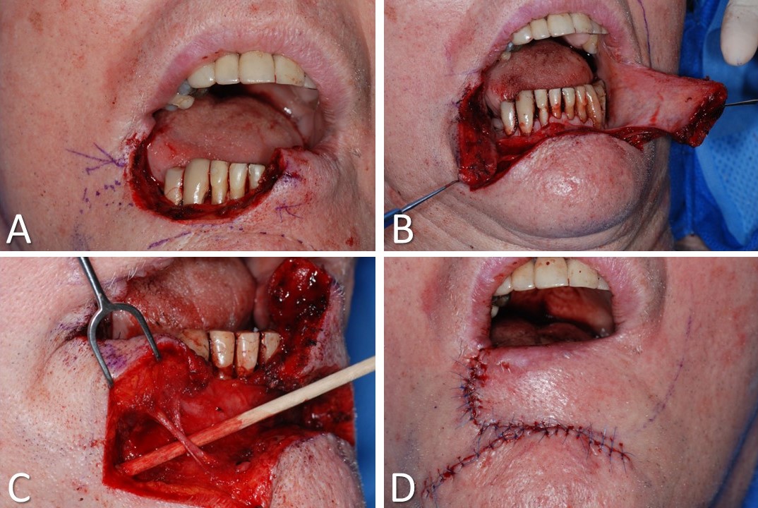 <p>Karapandzic-Type Advancement of the Lower Lip