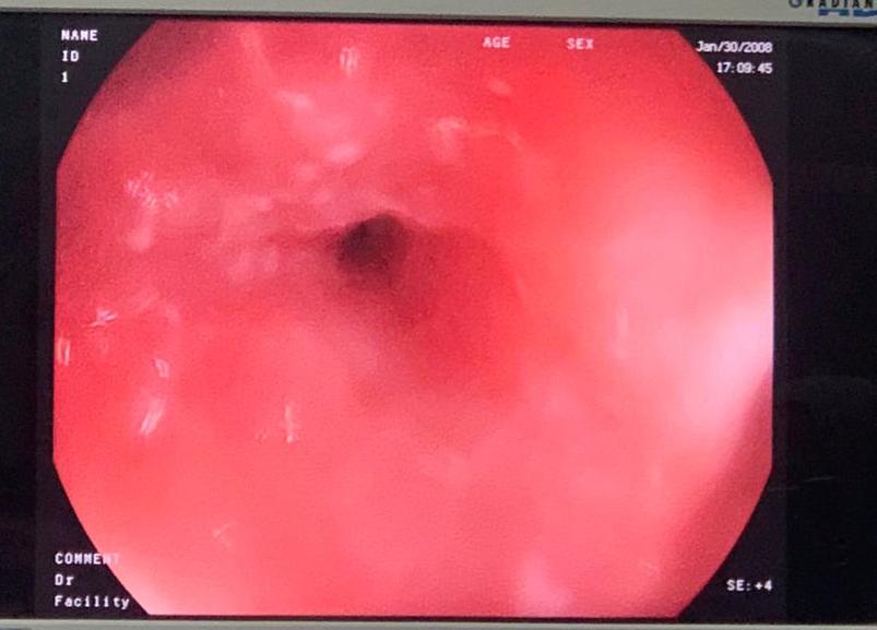 <p>Esophagus Examination On Esophagogastroduodenoscopy