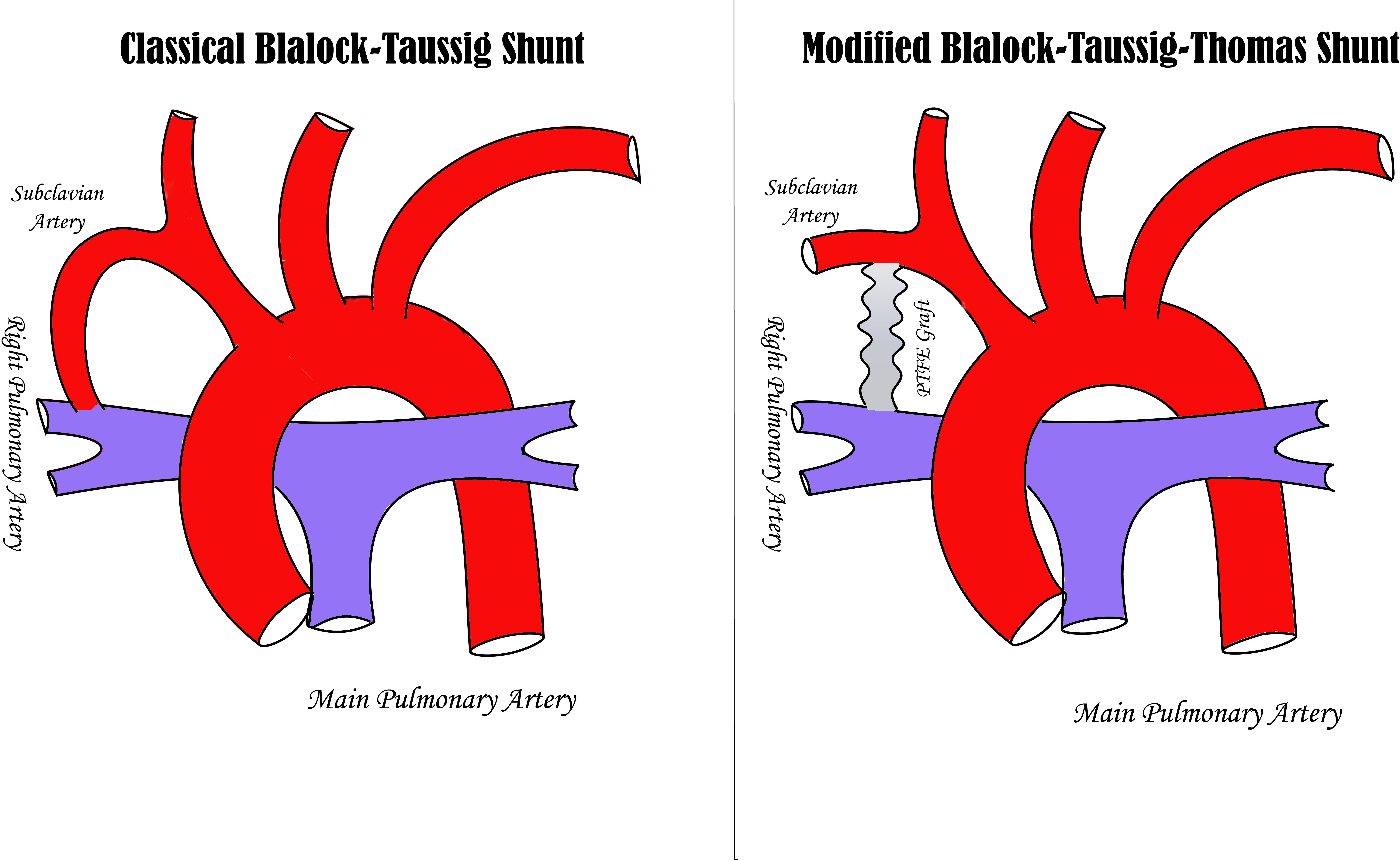 <p>Classic Blalock-Taussig Shunt vs