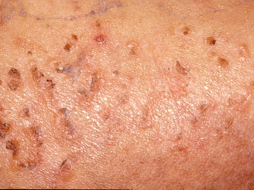 <p>Prurigo pigmentosa, hyperpigmentation