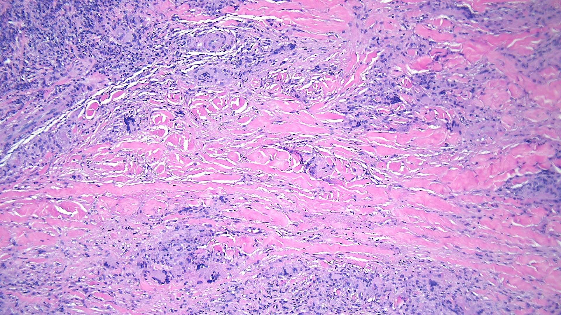 <p>High-Power Pathological Findings of Necrobiosis Lipoidica: Skin Biopsy</p>