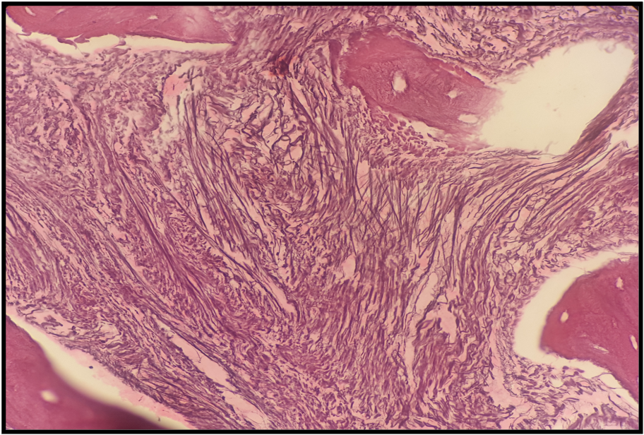 <p>Grade 3 Bone Marrow Fibrosis