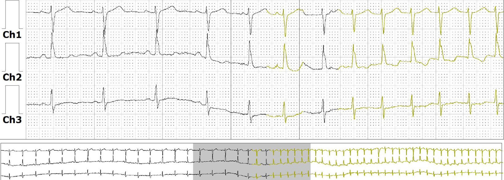 <p>Holter Monitor Data Output. A Holter monitor recording reveals the start of supraventricular tachycardia.</p>