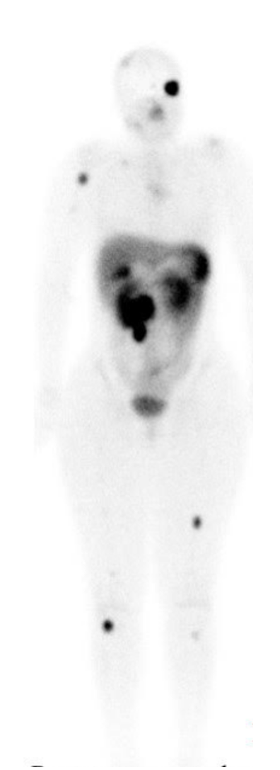 Post-lutetium therapy planar image of the whole body demonstrating multiple lesions in the osseous structures.