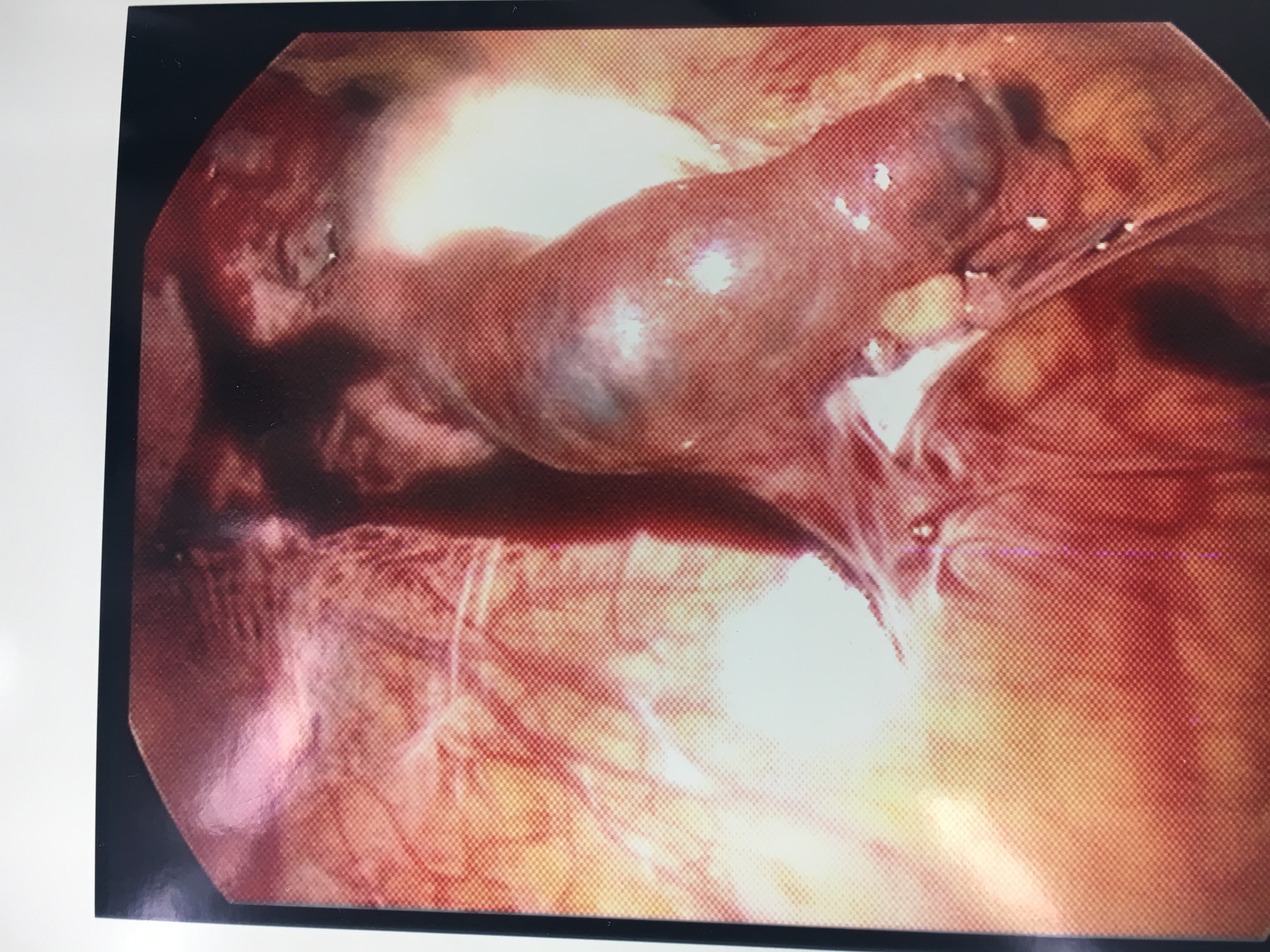 <p>Tubal Ectopic Pregnancy