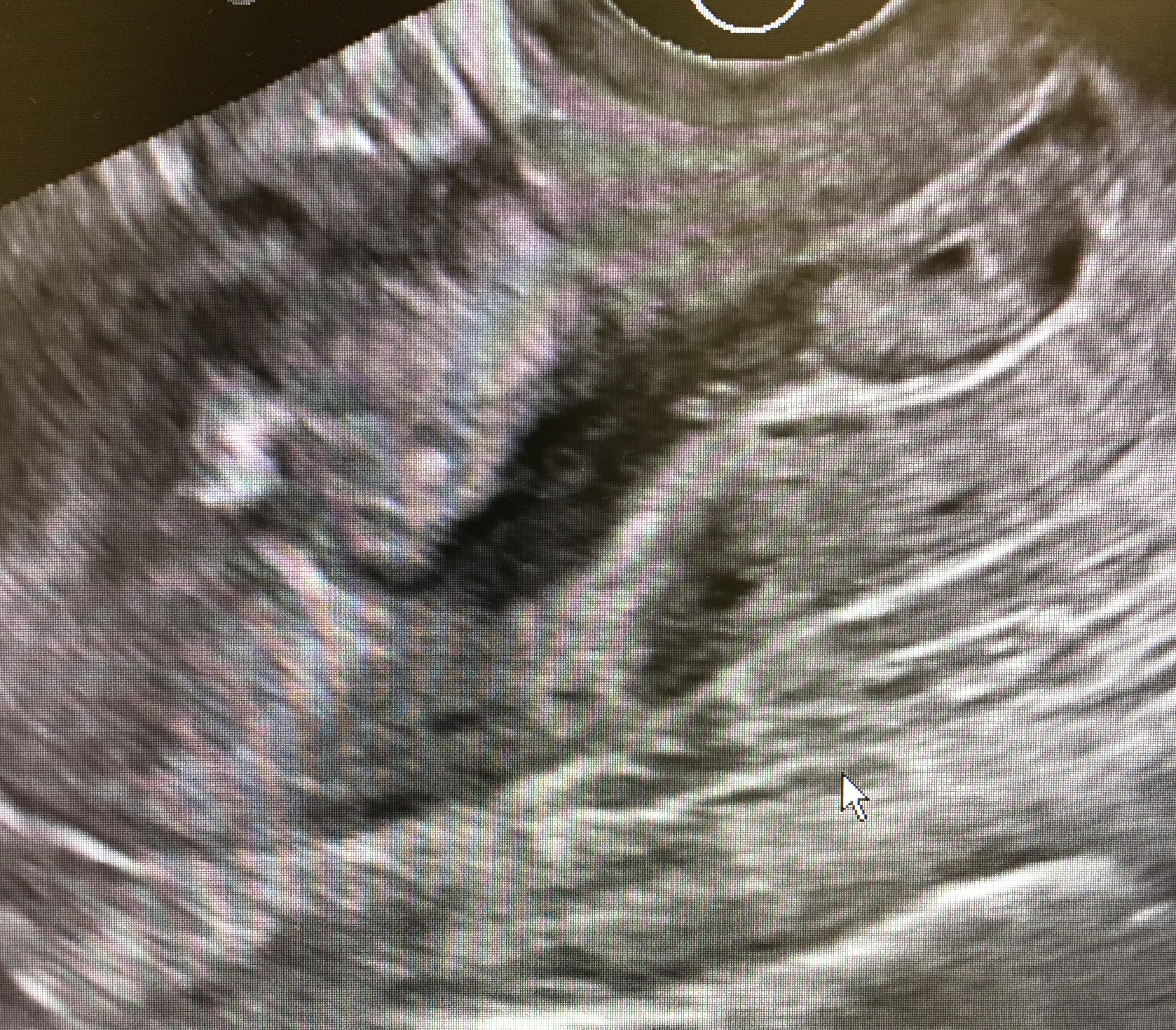 <p>Cervical Ectopic Pregnancy. Ultrasound image demonstrating an ectopic pregnancy within the endocervical canal.</p>