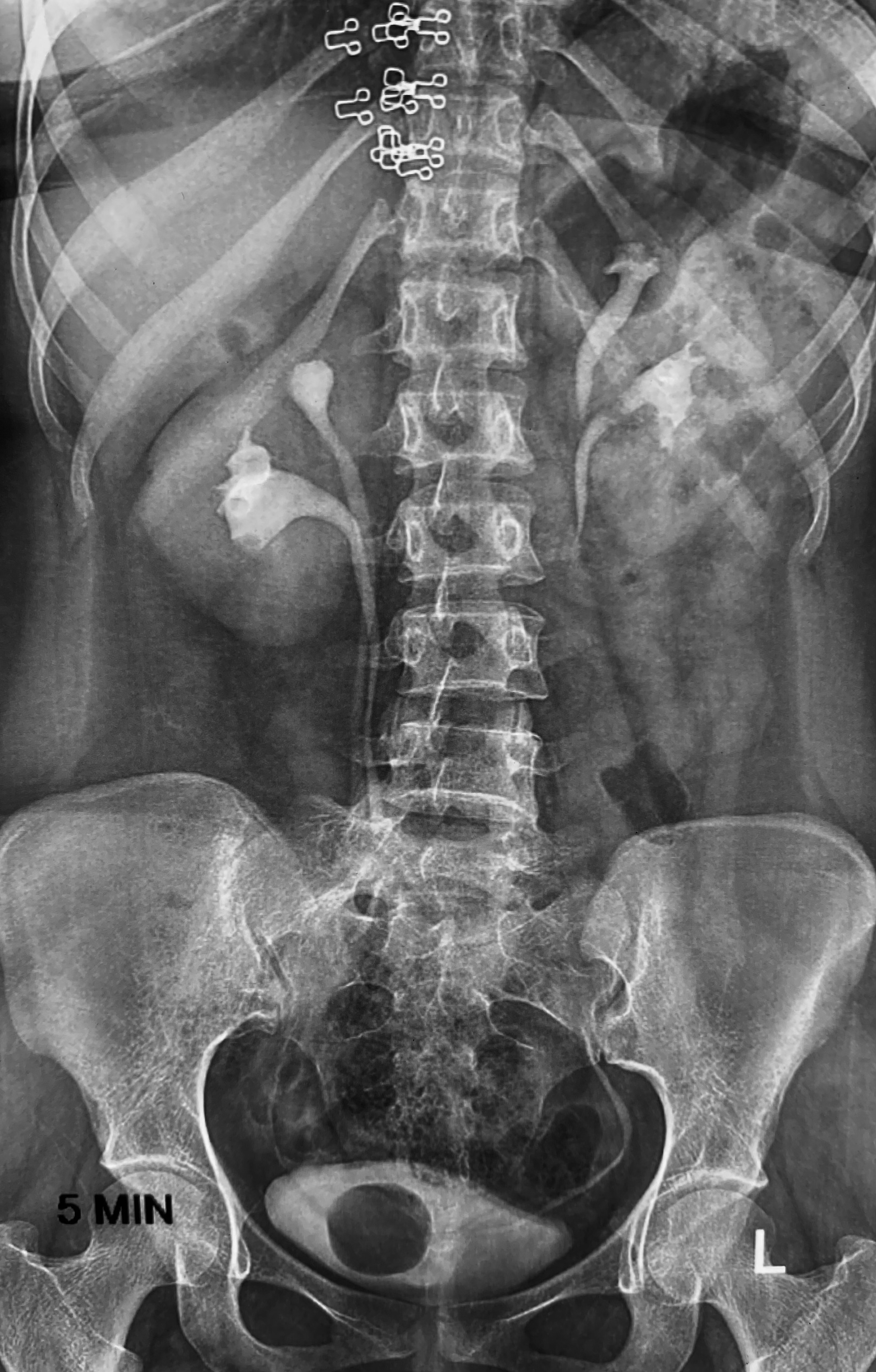 <p>Intravenous Pyelogram Shows Bilateral Duplex Kidneys