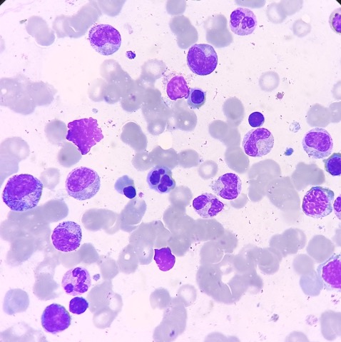 <p>Nuclear Budding. Bone marrow aspirate showing erythroid dysplasia.</p>