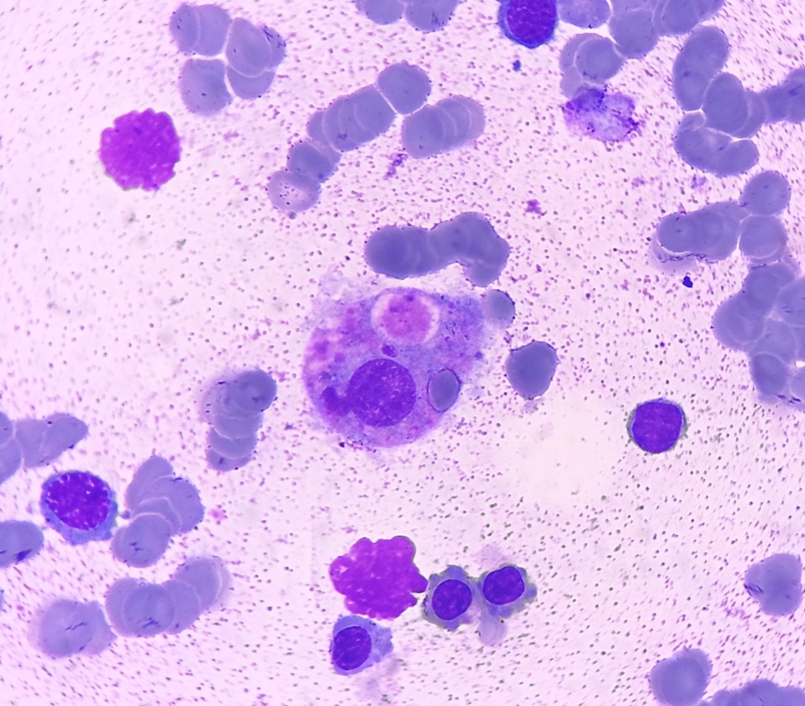 <p>Erythrophagocytosis. Bone marrow aspirate showing erythrophagocytosis.</p>