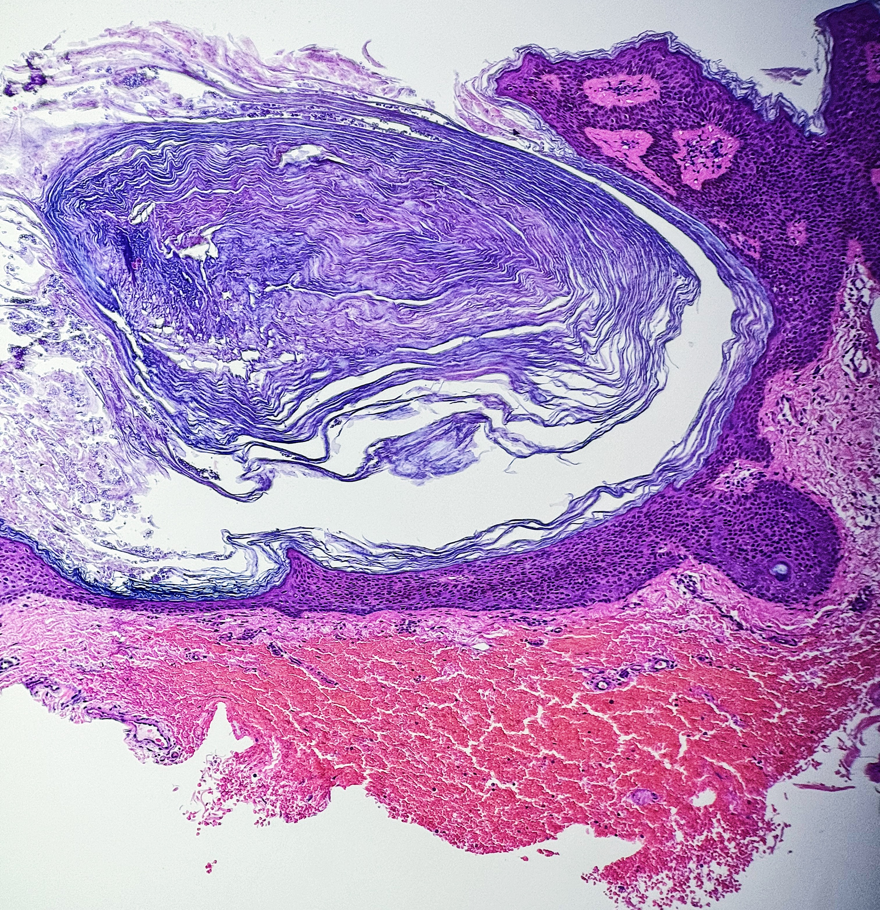 <p>Histology Hemorrhage. Procedural-related hemorrhage underlying seborrheic keratosis.</p>