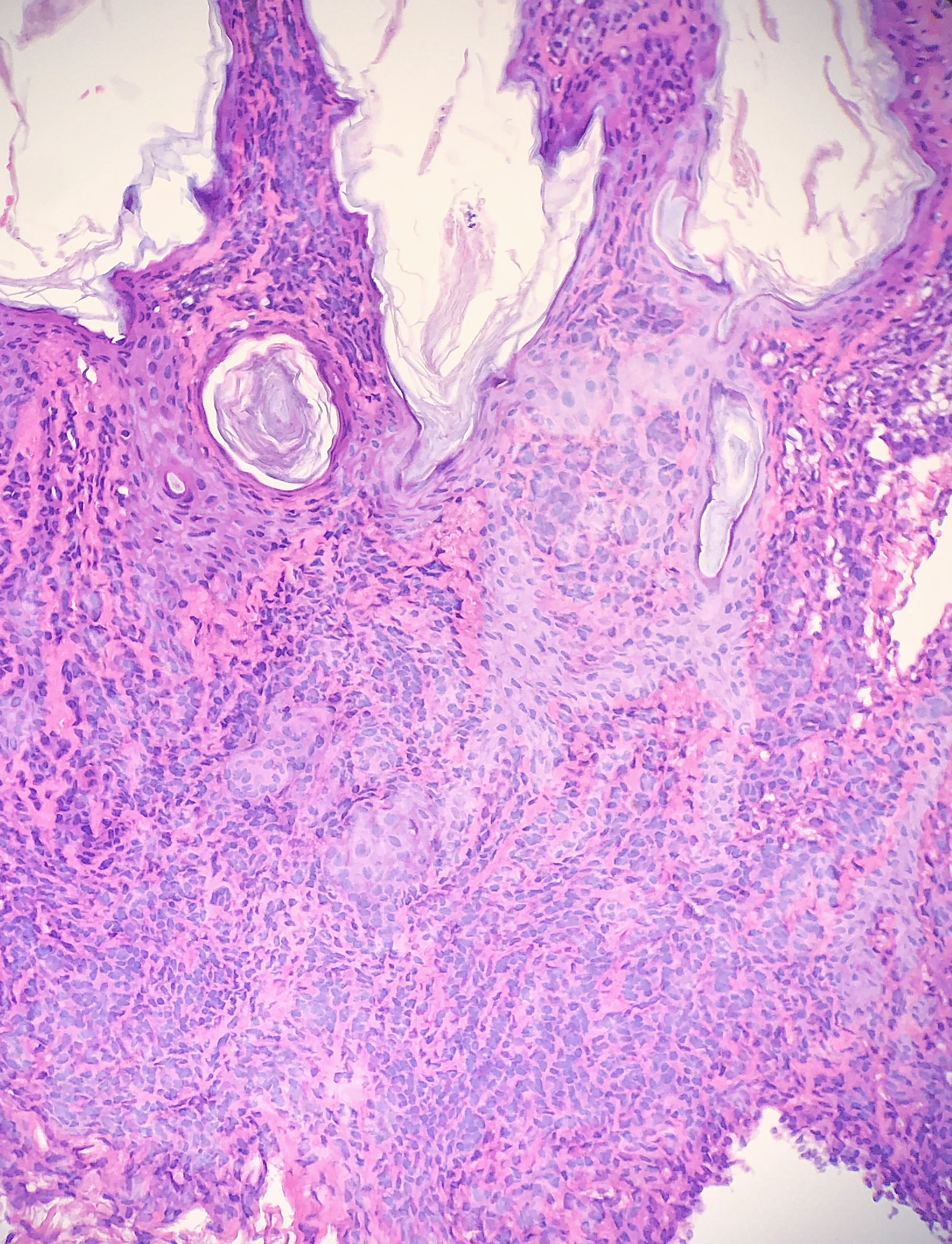 <p>Poorly-Fixed Specimen. Staining artifact in a poorly-fixed tissue specimen.</p>