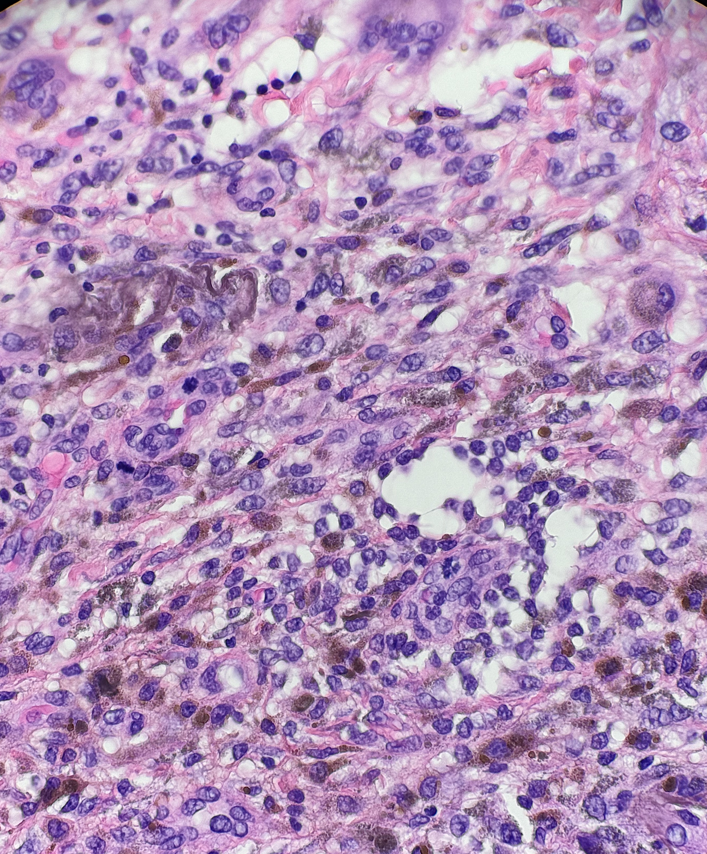 <p>Ferrous Subsulfate. There is stippled pigment within histocytes along with the characteristic smudgy brown material.</p>