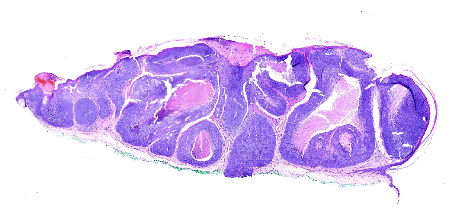 <p>Sebaceous Carcinoma, Low-Power Field</p>