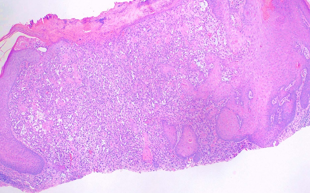 <p>Squamous Cell Carcinoma.</p>