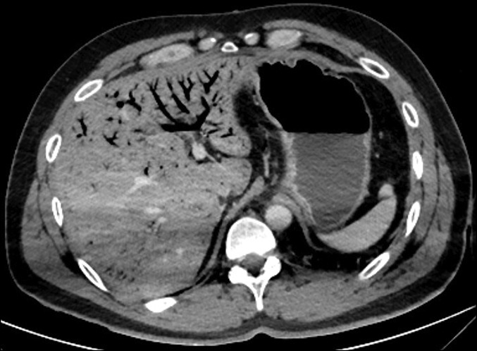 <p>Gas in Portal System. Computed tomography scan showed gas filling the portal system</p>