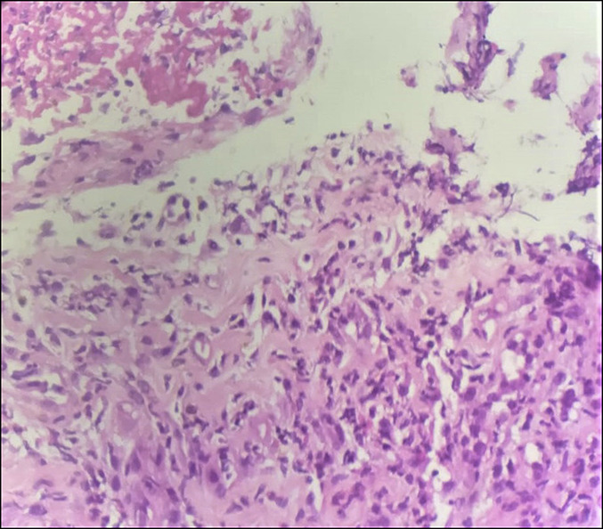 <p>Esophageal Biopsies