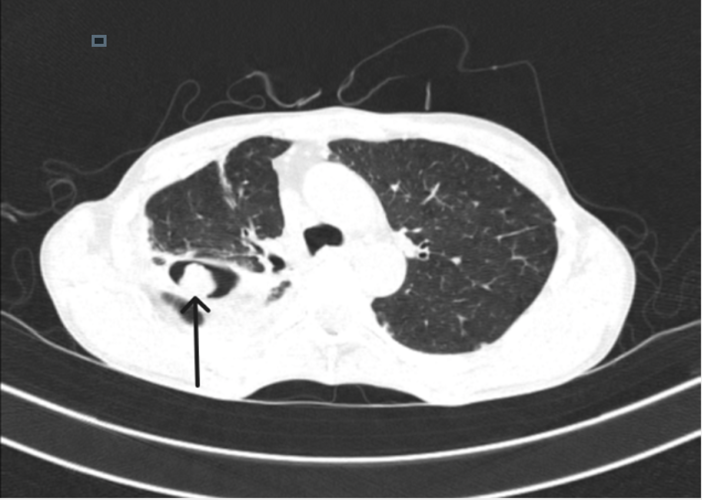 <p>CT Scan of the Lung Showing Aspergilloma Mass With Monod Sign