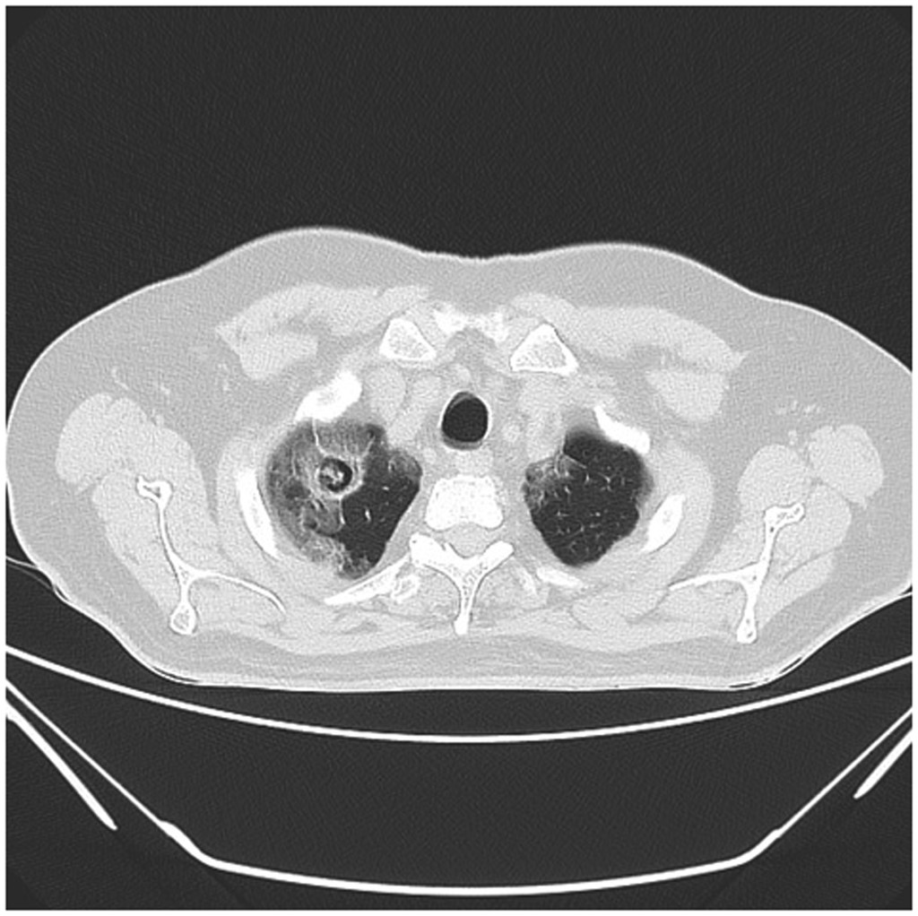 <p>HRCT Chest Scan Showing Aspergilloma With SARS-CoV-2 Pneumonitis Features