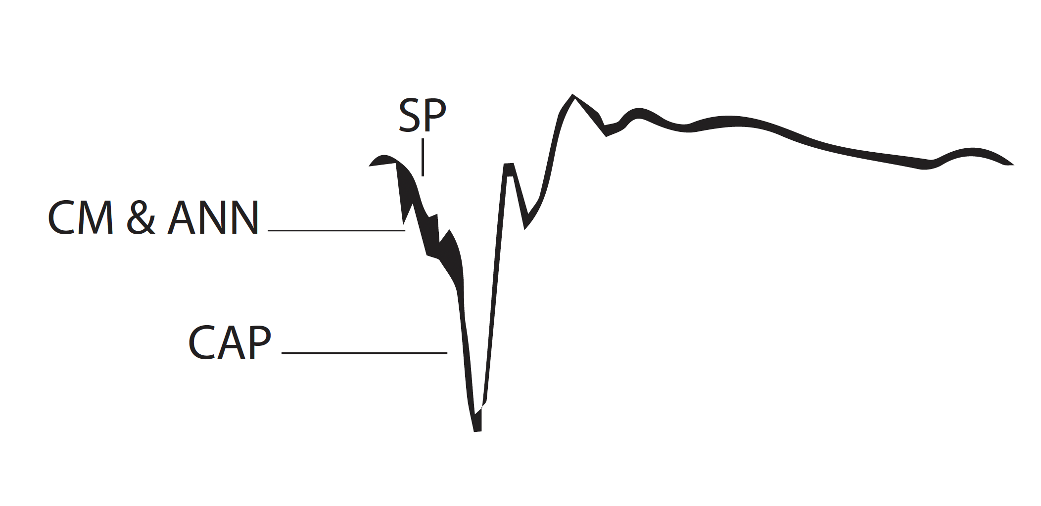 <p>Electrocochleography Tracing