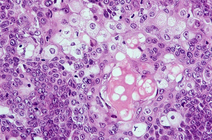 <p>Sebaceous Carcinoma, High-Power Field</p>