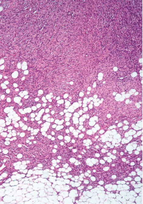 <p>Dermatofibrosarcoma Protruberans, Low-Power Field</p>