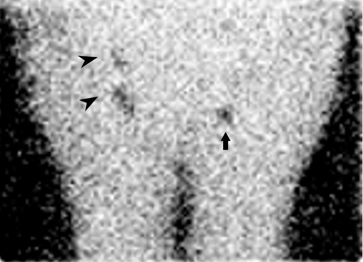 <p>Lymphoscintigraphy, Lymphedema