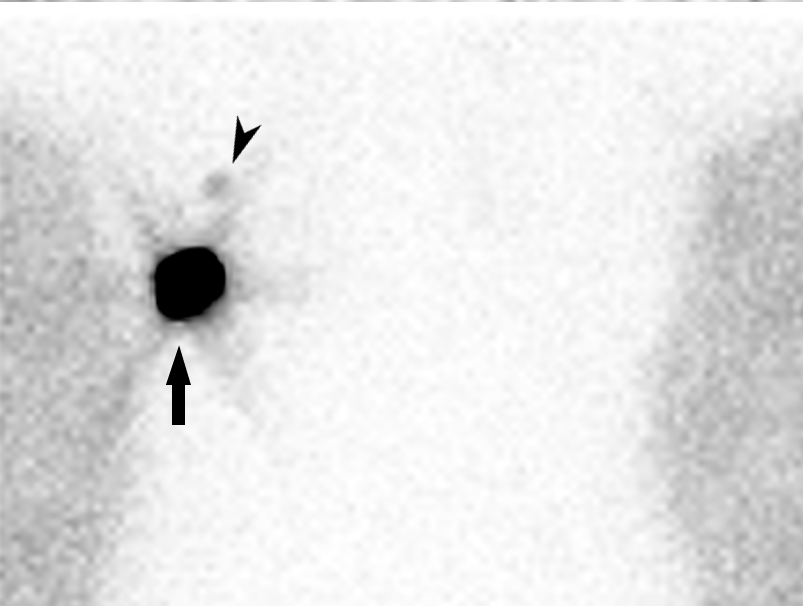 <p>Lymphoscintigraphy, Breast Cancer