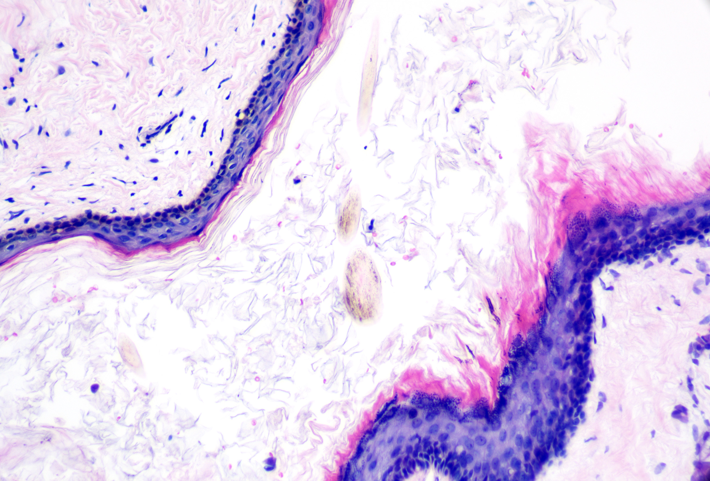 <p>Pigmented Follicular Cyst