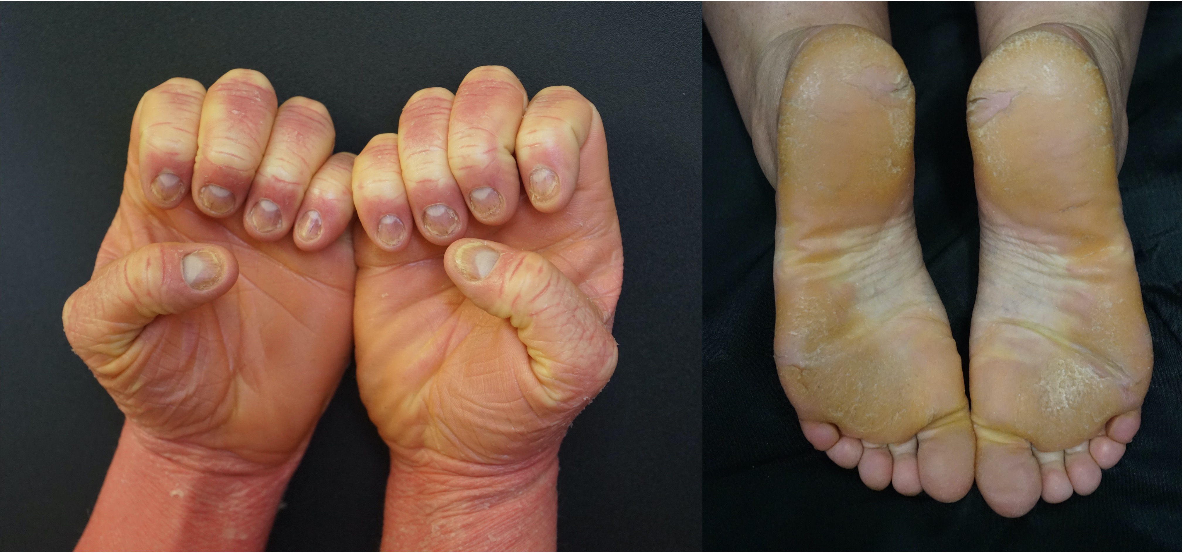 <p>Pityriasis Rubra Pilaris With Keratoderma. PRP with waxy orange-red palmar and bright yellow plantar keratoderma.</p>