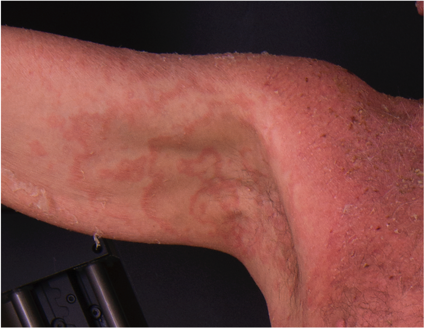 <p>Gyratum-Repens-Like Pityriasis Rubra Pilaris. PRP with axillary erythema gyratum-repens-like morphology.</p>