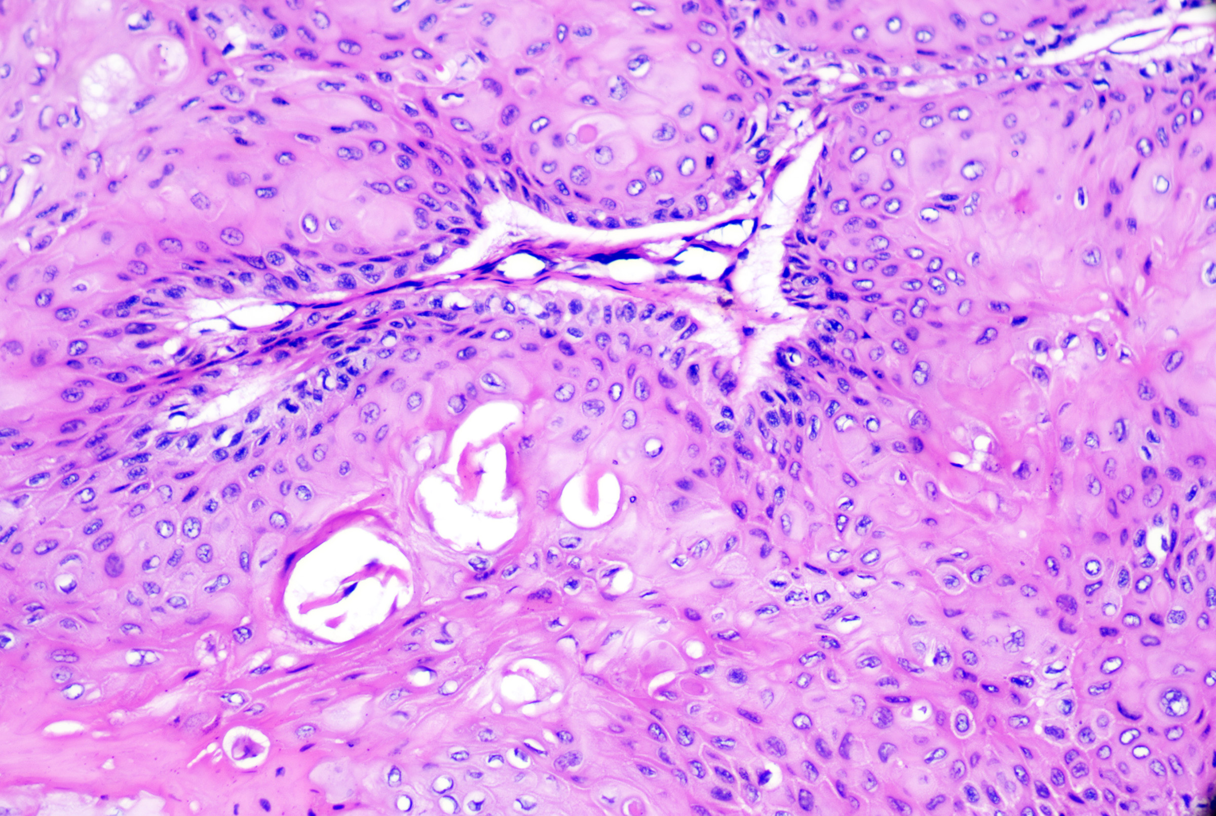 <p>Proliferating Pilar Tumor Epithelium