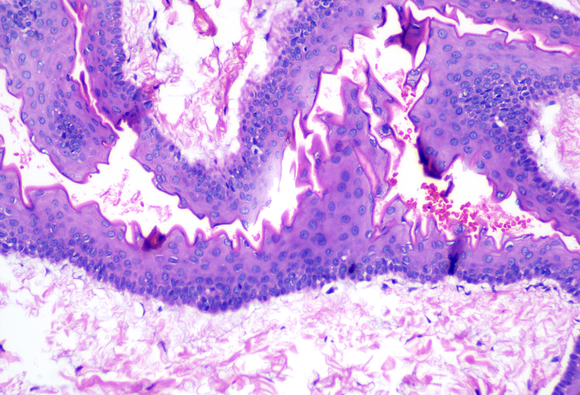 <p>Steatocystoma