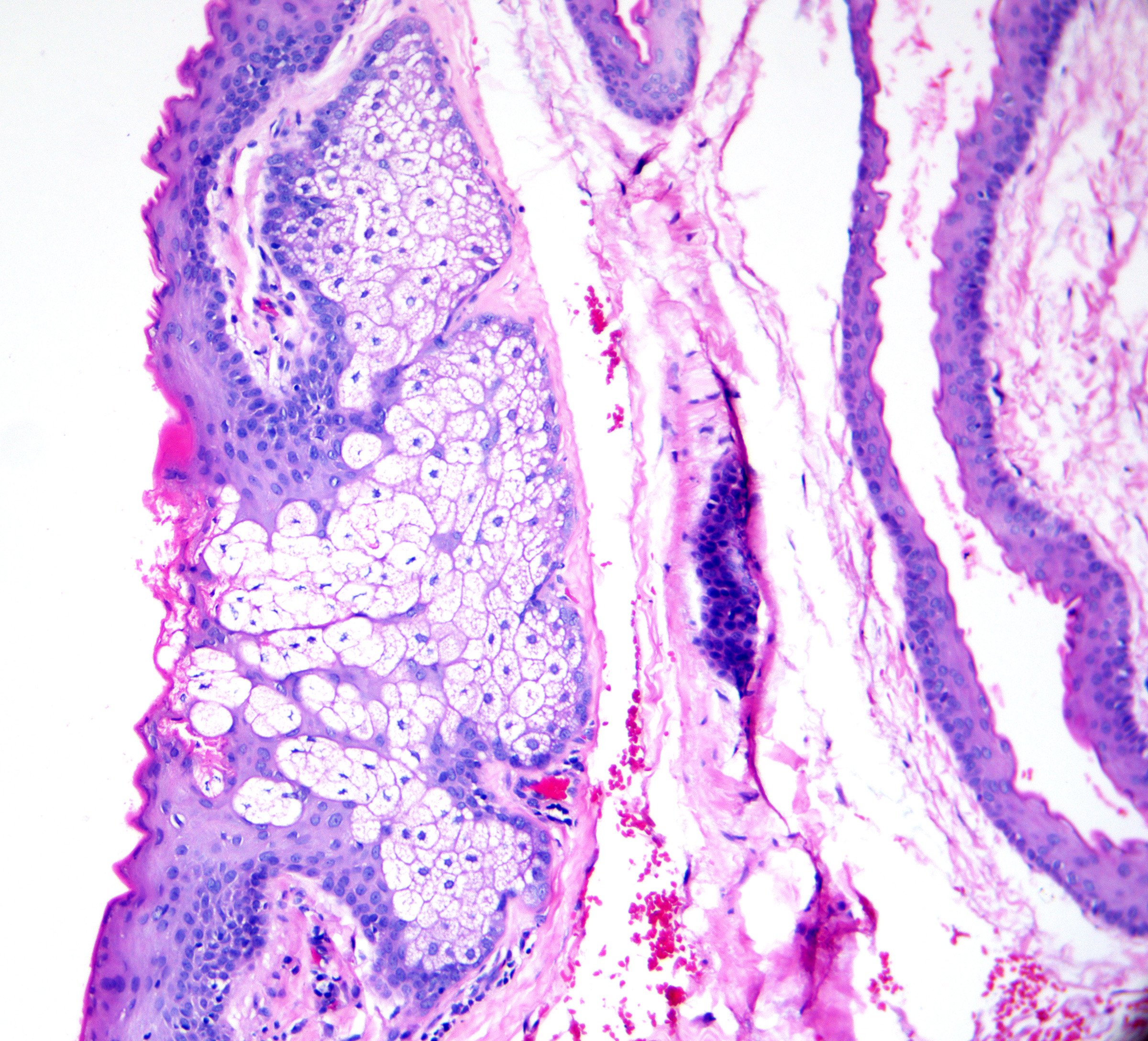 <p>Steatocystoma Cuticle