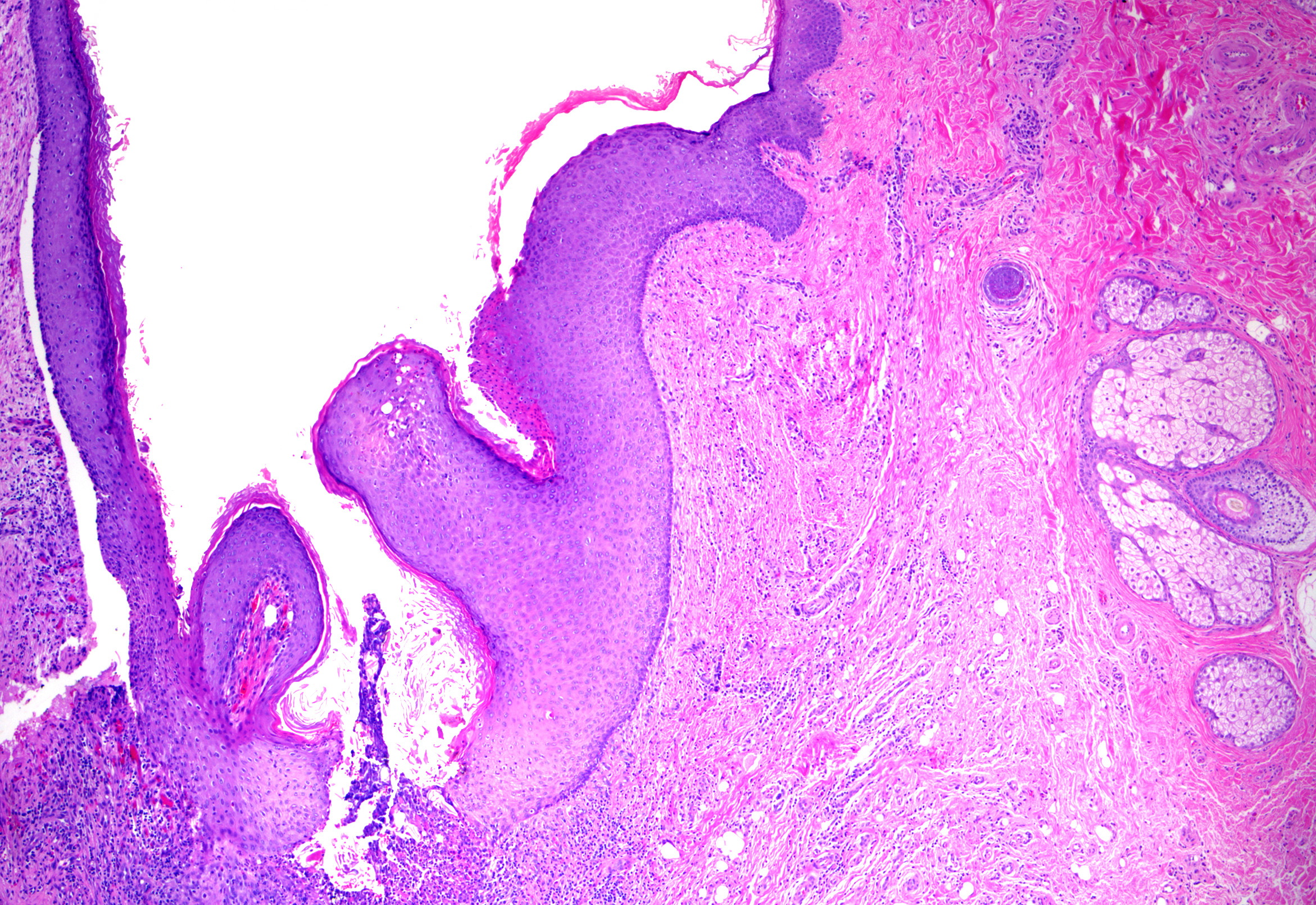 <p>Dermoid Cyst