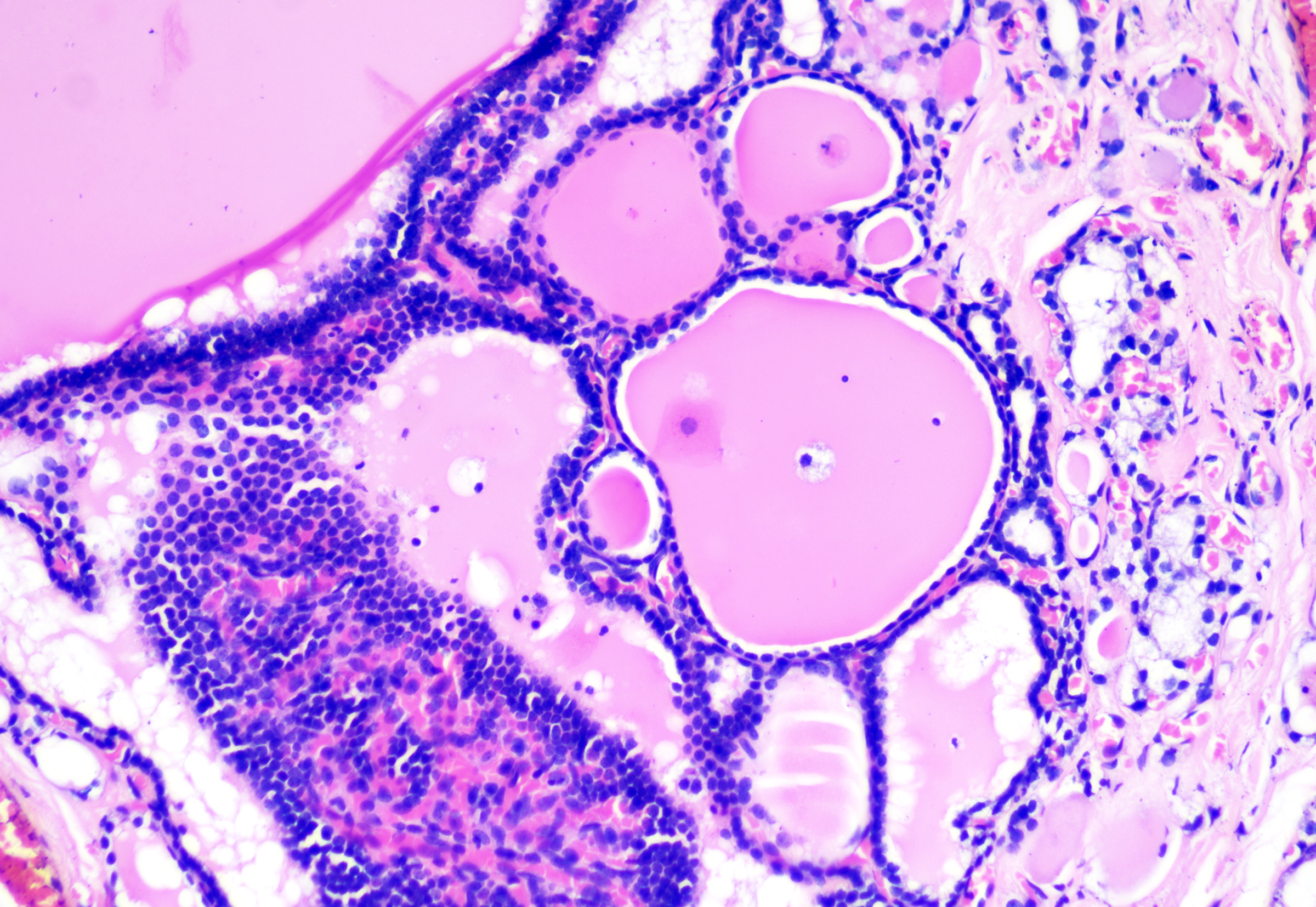 <p>Thyroglossal Cyst With Follicles