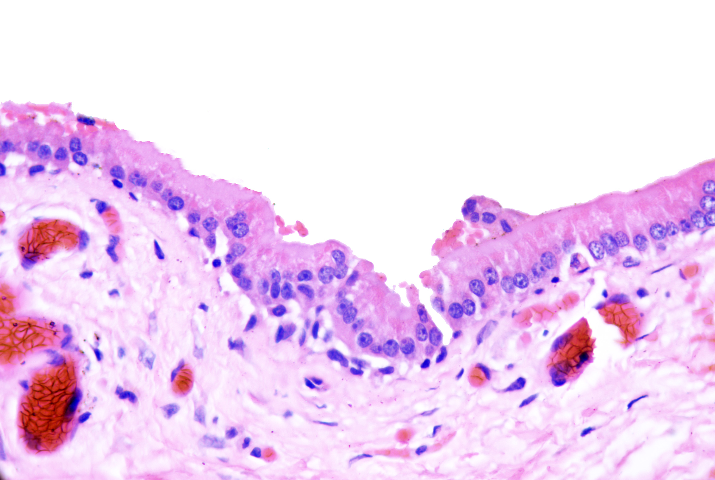 <p>Apocrine Hidrocystoma