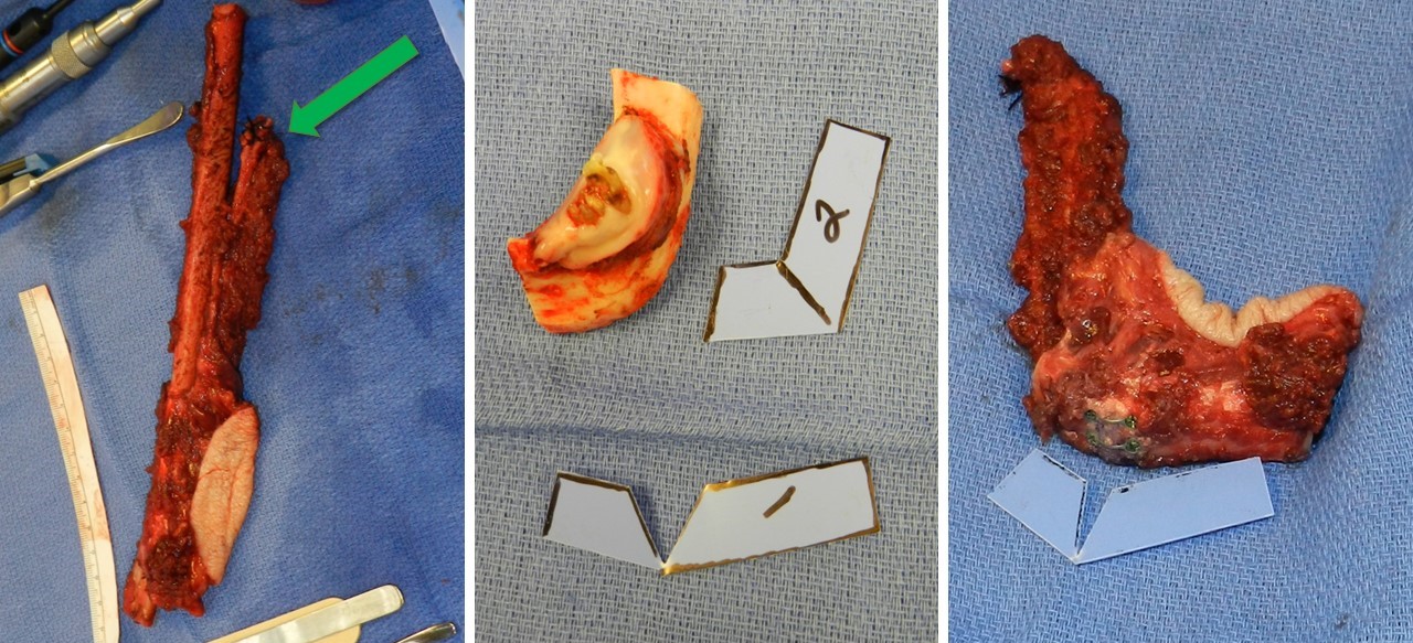 <p>Fibula Free Flap Harvest and Closing Ostectomy