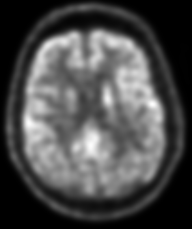 <p>F18 FDG PET/CT Brain Scan Revealing Dementia With Lewy Bodies