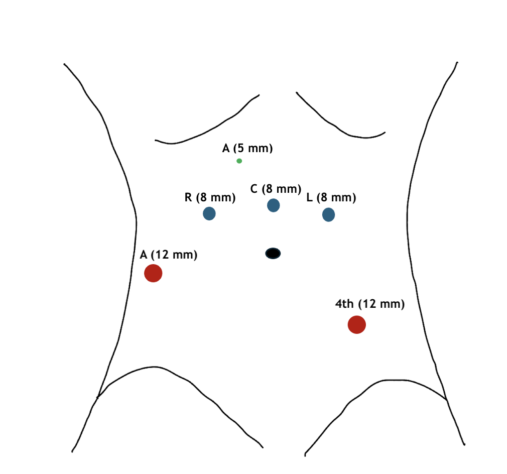 <p>Port Placement for Robotic Radical Cystectomy</p>