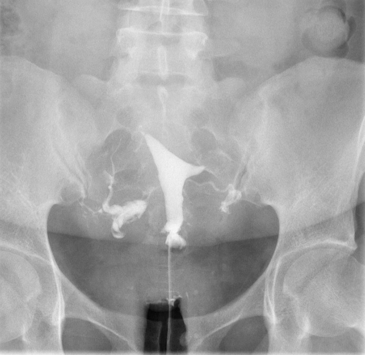 <p>Peritoneal Dye Spillage on Hysterosalpingogram