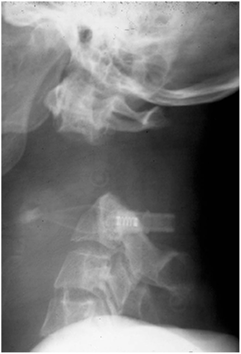 <p>Atlantoaxial Dissociation Radiography