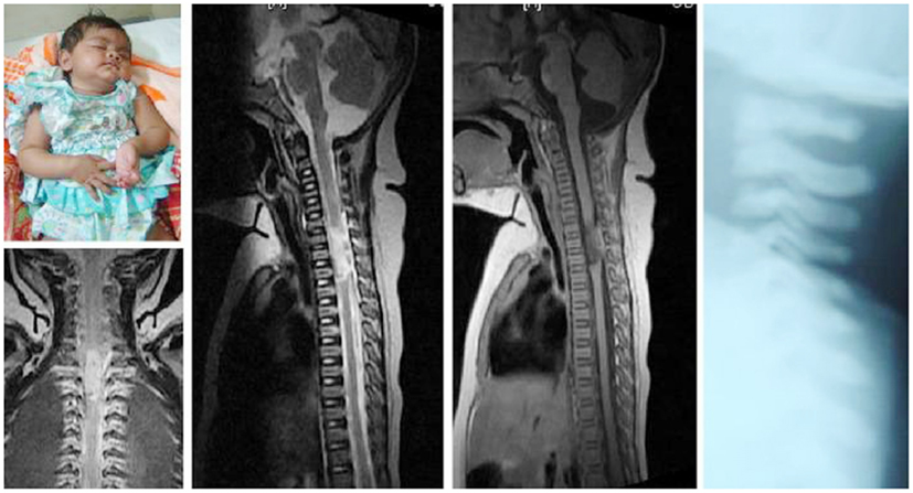 <p>SCIWORA on MRI