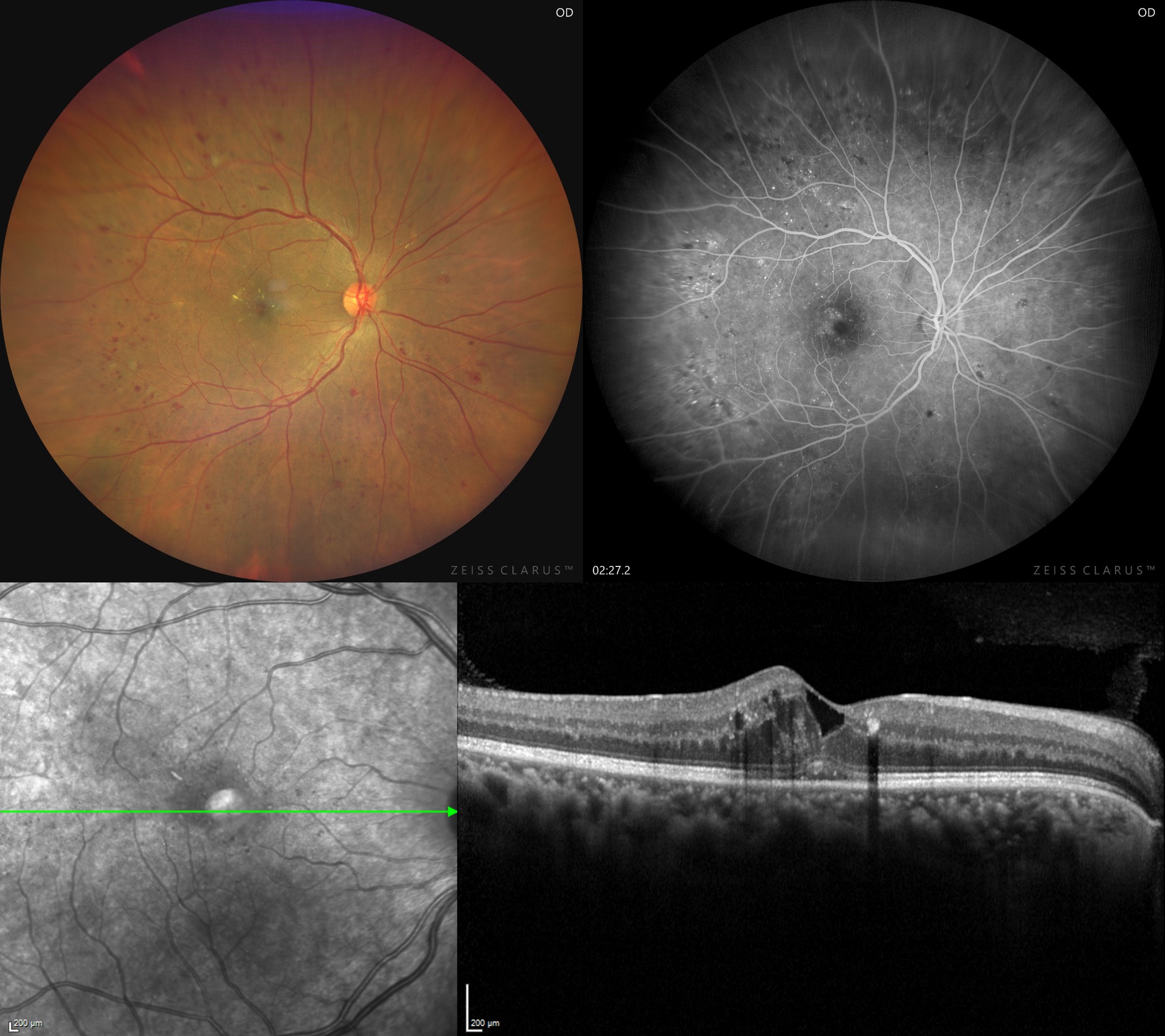 <p>Multimodal Imaging of Diabetic Macular Edema