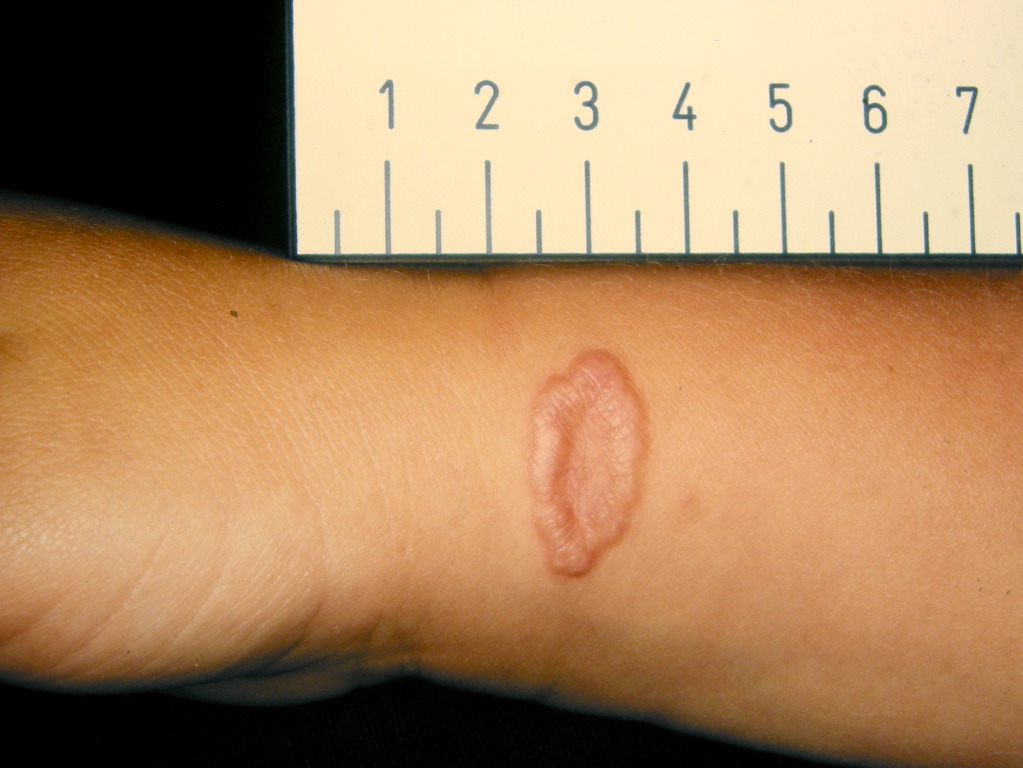 <p>Granuloma Annulare</p>